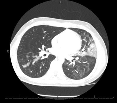 Case report: Clinical course and treatment of SARS-CoV-2 in a pediatric CAR-T cell recipient with persistent hypogammaglobulinemia